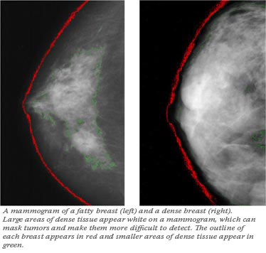 dense breast vs fatty breast